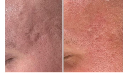 Exosomes Treatment for Facial Scarring Before & After
