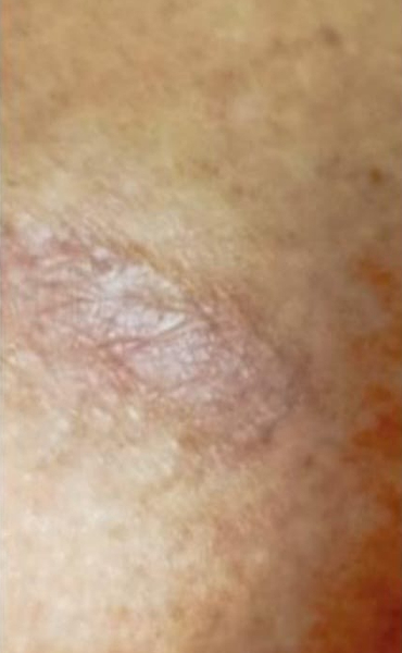 Exosomes Treatment for Scars Before