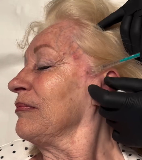 Exosomes Treatment on Face Skin Laxity
