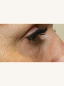 Eye Treatment Wrinkles After