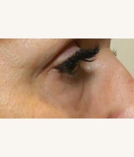 Eye Treatment Wrinkles After