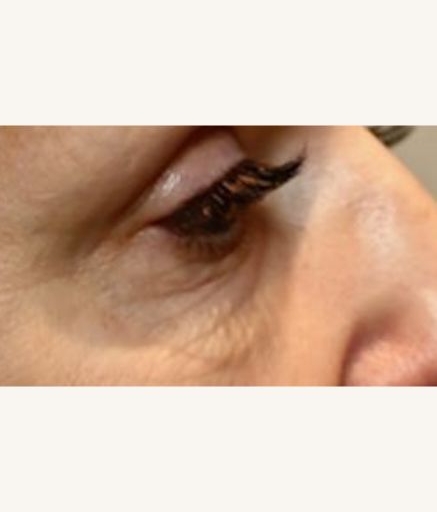 Eye Treatment Wrinkles Before