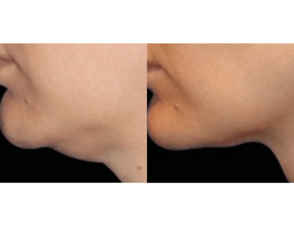 Facial Fat Loss Before & After