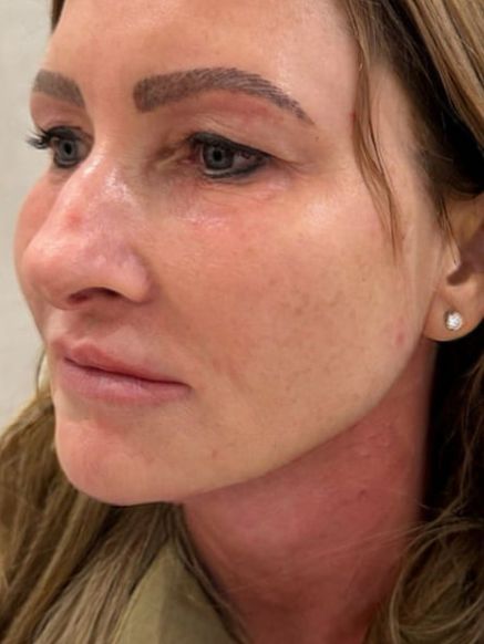 Jawline Enhancement After