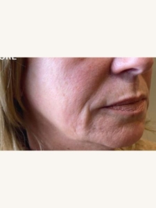 Jowls Botox Before