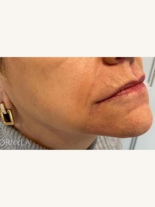 Jowls Treatment After