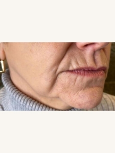 Jowls Treatment Before