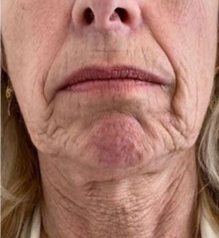 Nasolabial Folds Treatment