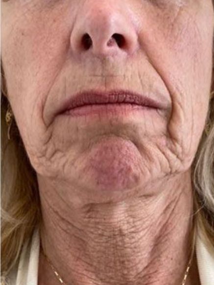 Nasolabial Folds Treatment