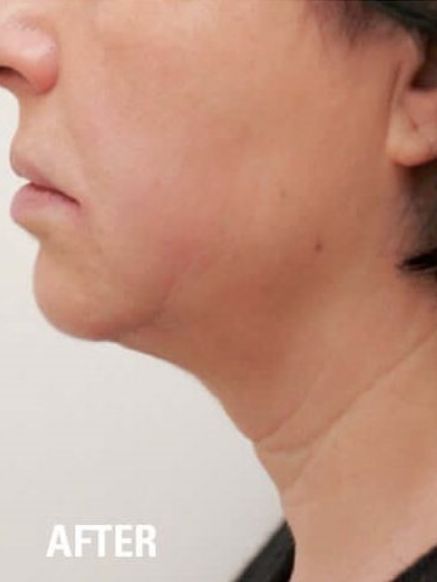 Ultraformer 3 Jowls Skin Tightening After