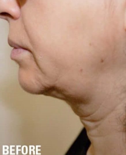 Ultraformer 3 Jowls Skin Tightening Before