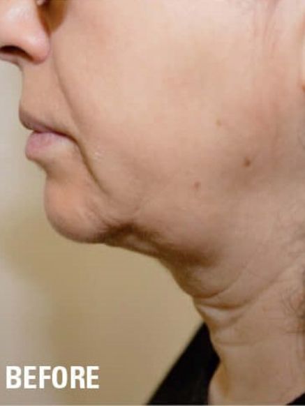 Ultraformer 3 Jowls Skin Tightening Before