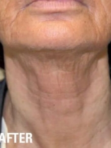 Ultraformer 3 Neck Skin Tightening After