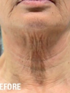 Ultraformer 3 Neck Skin Tightening Before