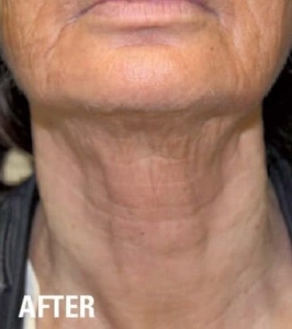 Ultraformer HIFU Turkey Neck After