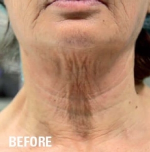 Ultraformer HIFU Turkey Neck Before