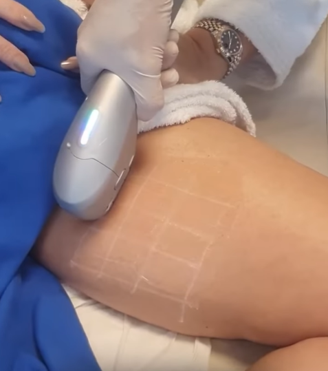 Ultraformer Treatment on Thighs