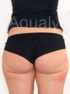 Aqualyx Fat Dissolving After