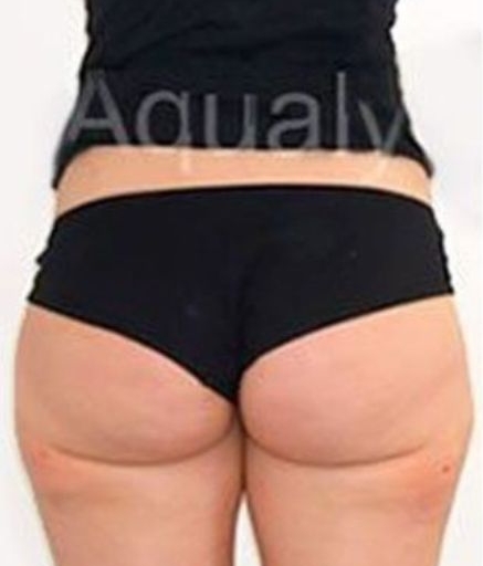 Aqualyx Fat Dissolving After