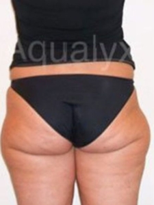 Aqualyx Fat Dissolving Before