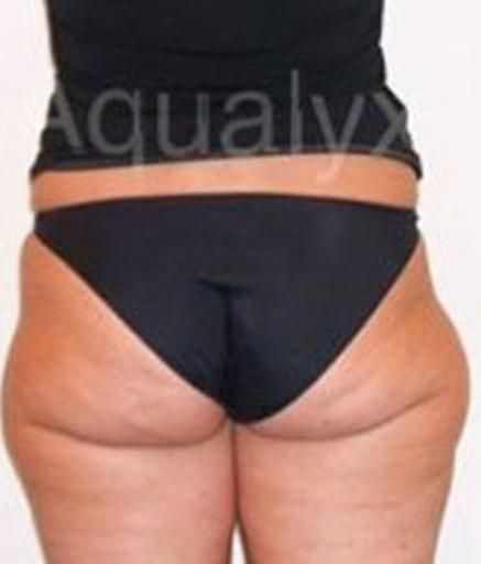 Aqualyx Fat Dissolving Before