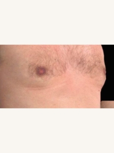 CoolSculpting Men's Chest Fat After