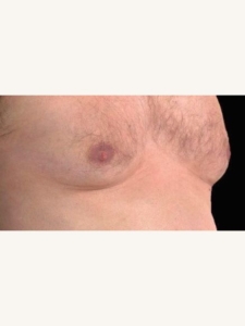 CoolSculpting Men's Chest Fat Before