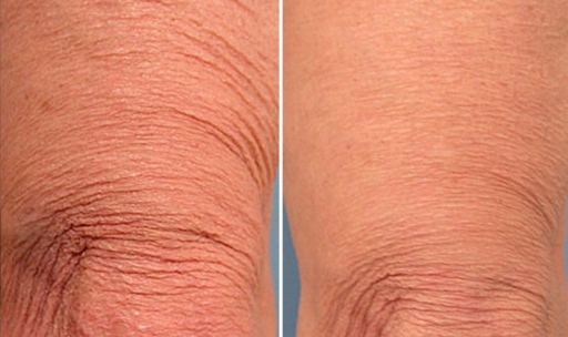 Leg Skin Tightening Before & After