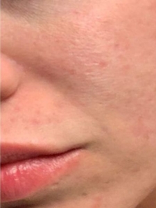 Morpheus8 Treatment on Acne Spots After