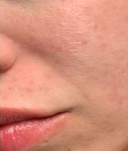 Morpheus8 Treatment on Acne Spots After