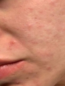 Morpheus8 Treatment on Acne Spots Before