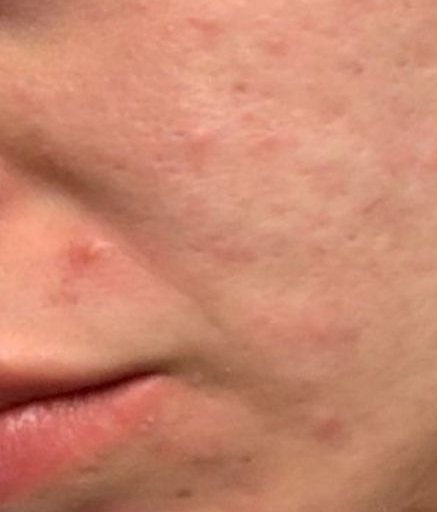 Morpheus8 Treatment on Acne Spots Before
