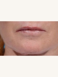 Morpheus8 Treatment on Lip Wrinkles After