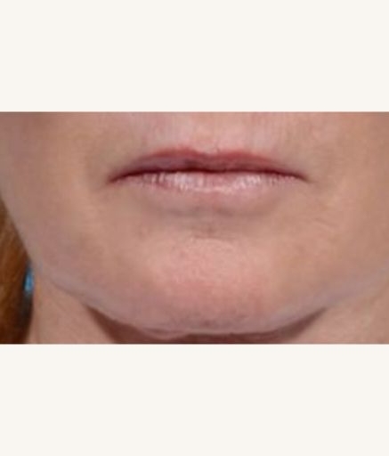 Morpheus8 Treatment on Lip Wrinkles After