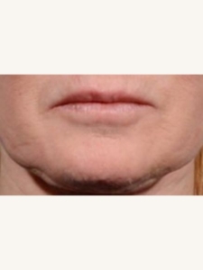 Morpheus8 Treatment on Lip Wrinkles Before