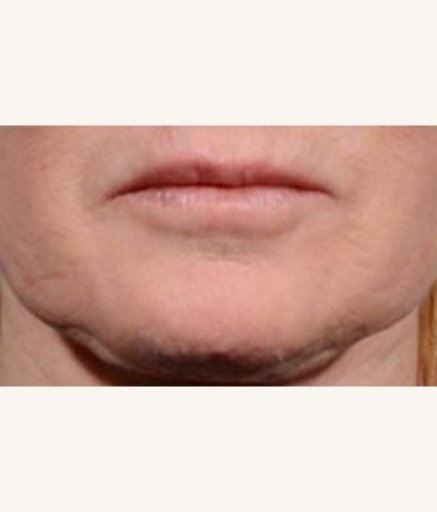 Morpheus8 Treatment on Lip Wrinkles Before