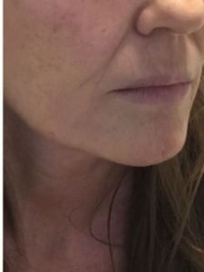 Morpheus8 Treatment on Lower Face Wrinkles After