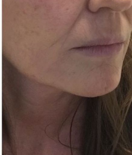 Morpheus8 Treatment on Lower Face Wrinkles After