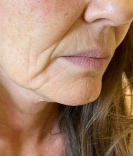 Morpheus8 Treatment on Lower Face Wrinkles Before