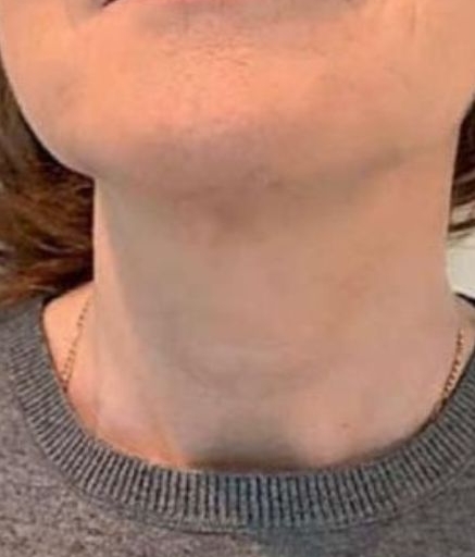 Morpheus8 Treatment on Neck Wrinkles After