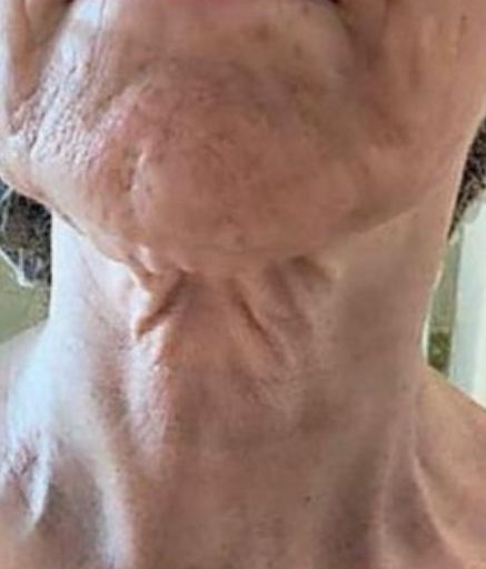 Morpheus8 Treatment on Neck Wrinkles Before