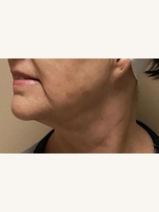 Morpheus8 Treatment on Saggy Skin After