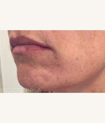 Morpheus8 Treatment on Wrinkles After