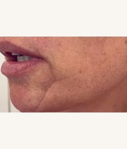 Morpheus8 Treatment on Wrinkles Before