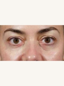 Tear Trough Fillers for Eye Bags After