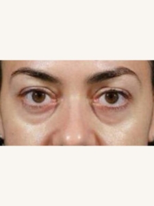 Tear Trough Fillers for Eye Bags Before