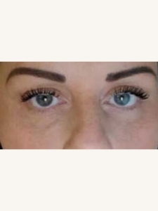 Tear Trough Fillers for Hollow Under Eyes After