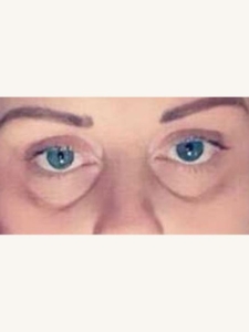 Tear Trough Fillers for Hollow Under Eyes Before