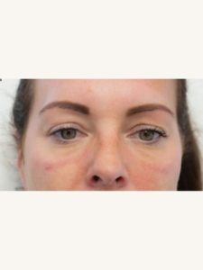 Tear Trough Fillers for Tired Eyes After