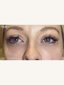 Tear Trough Fillers for Under-Eye Discolouration After